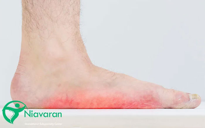 صافی کف پا چیست؟