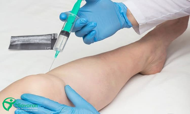 تزریق اوزون در زانو