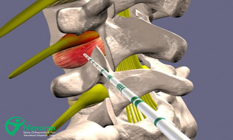 تزریق گاز اوزون در کمر