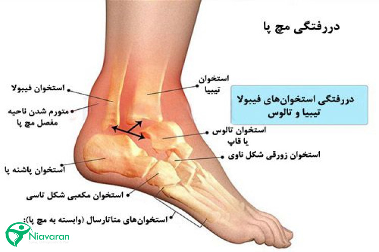آناتومی مچ پا و دررفتگی مفصل مچ پا