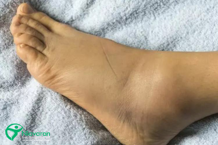 ورم و کبودی مچ پا