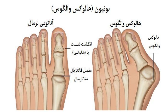 انحراف استخوان پا