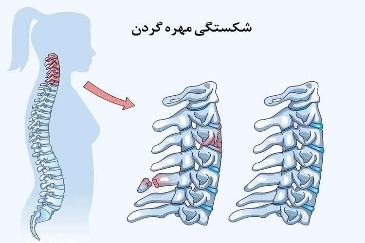 علائم شکستن مهره گردنی