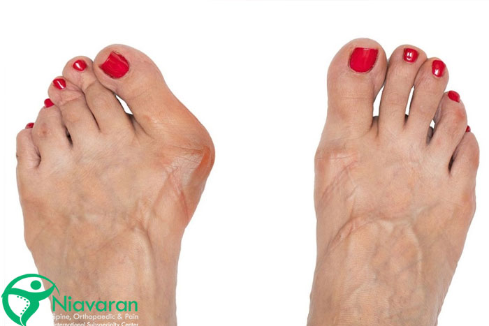 علت کج شدن انگشت شست پا چیست؟