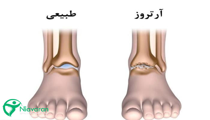 تفاوت مچ پا سالم با ساییدگی مچ