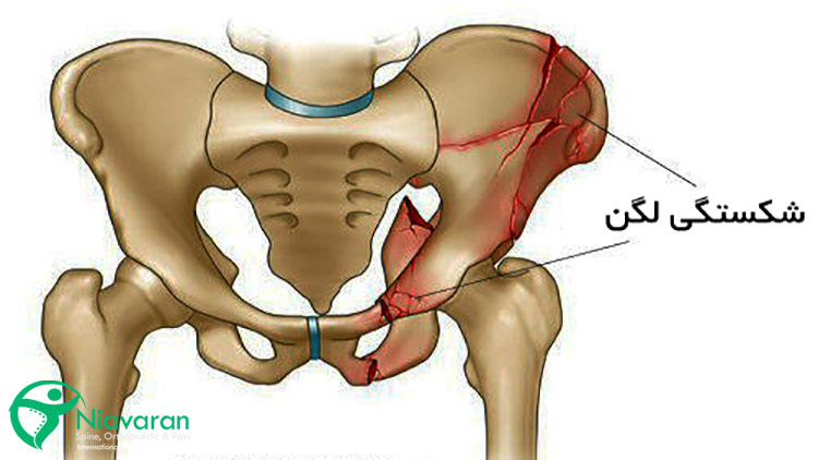 شکستگی شدید لگن