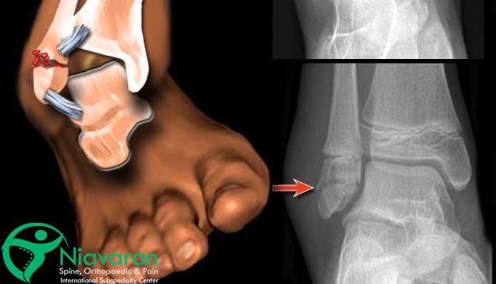 علائم شکستگی قوزک پا