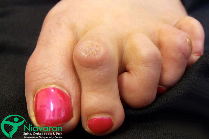 انگشت پای چکشی