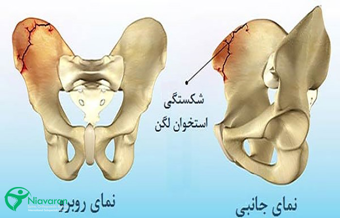 ترک خوردگی و شکستگی لگن 