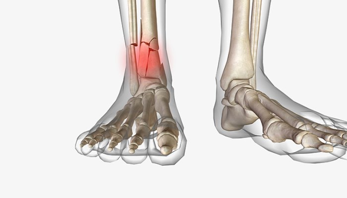 شکستگی استخوان در مچ پا