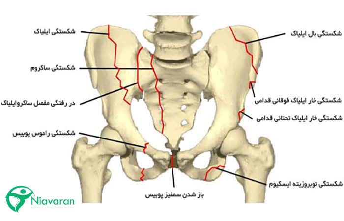 شکستگی در ناحیه لگن