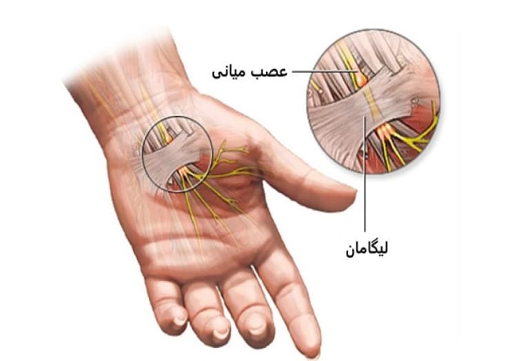 التهاب عصب میانی دست