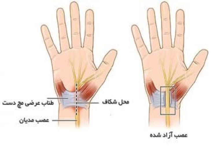 عصب دست آزاد شده در عمل جراحی