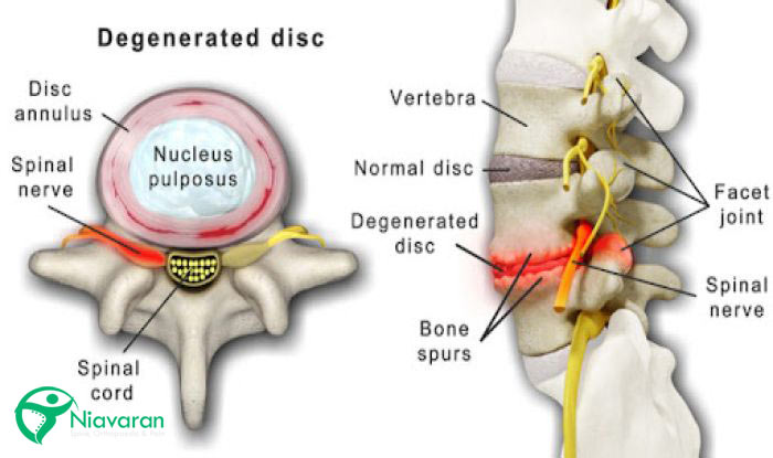 دژنراتیو دیسک
