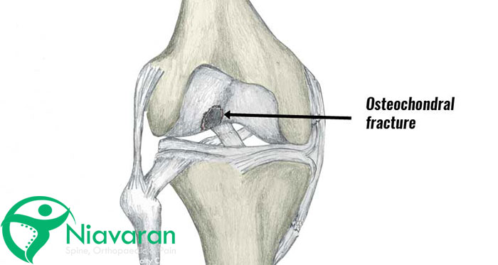 استئوکندرال زانو چیست