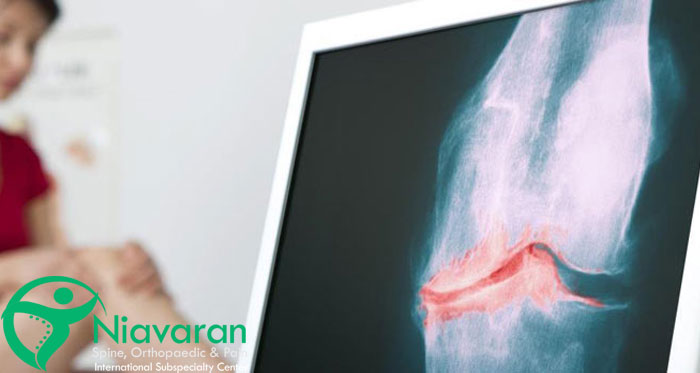 ضایعه استئوکندرال زانو