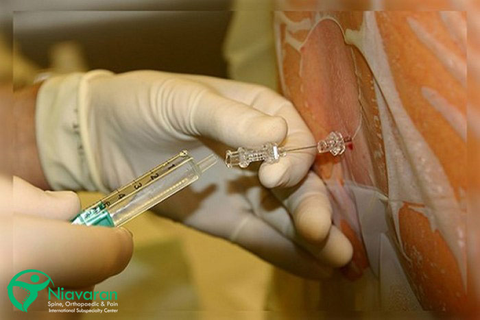 عوارض تزریق اپیدورال