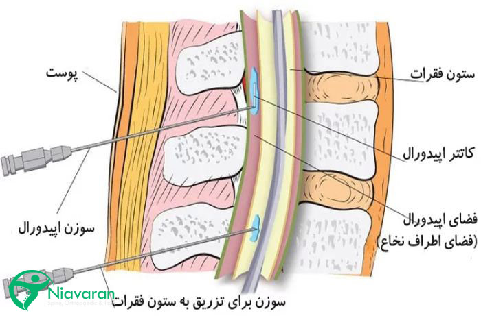 فضای اپیدورال کجاست