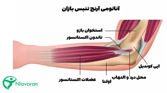 آناتومی آرنج در عارضه اپی‌کوندیلیت خارجی