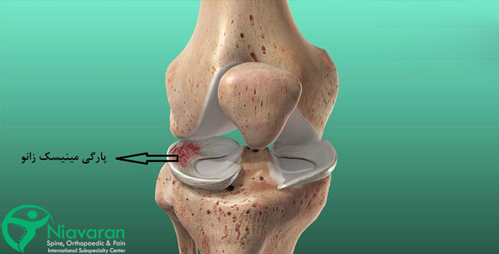 مینیسک زانو چیست