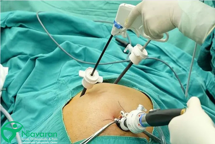 لاپاراسکوپی لگن