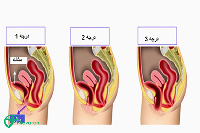 علائم پرولاپس لگن