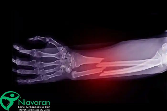 روش‌های تشخیص سندروم تونل کوبیتال