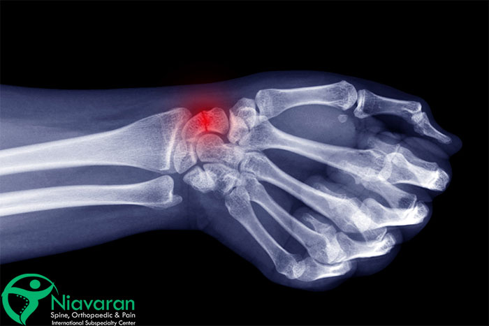 طول درمان شکستگی مچ دست