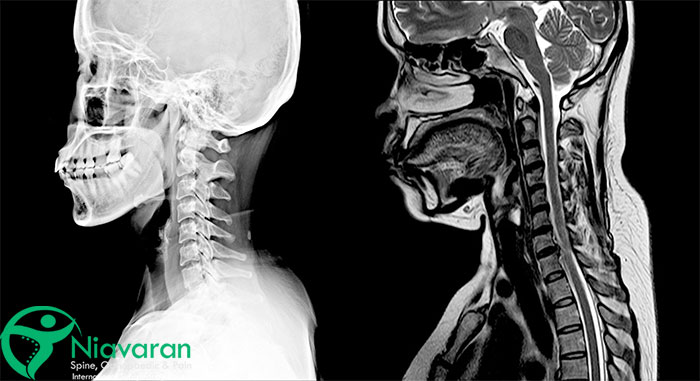 چه زمانی به ام آر آی گردن نیاز است؟