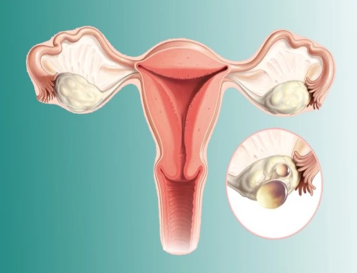 رحم و تخمدان