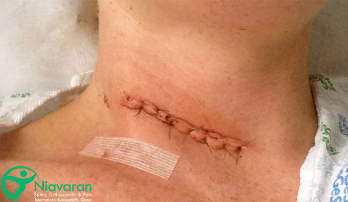 چگونه از رگ به رگ شدن گردن پیشگیری کنیم؟