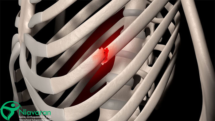 شکستگی دنده قفسه سینه