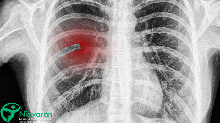 علائم شکستگی دنده سمت چپ