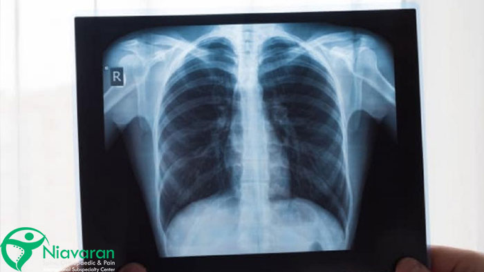 تشخیص شکستگی دنده با عکس برداری