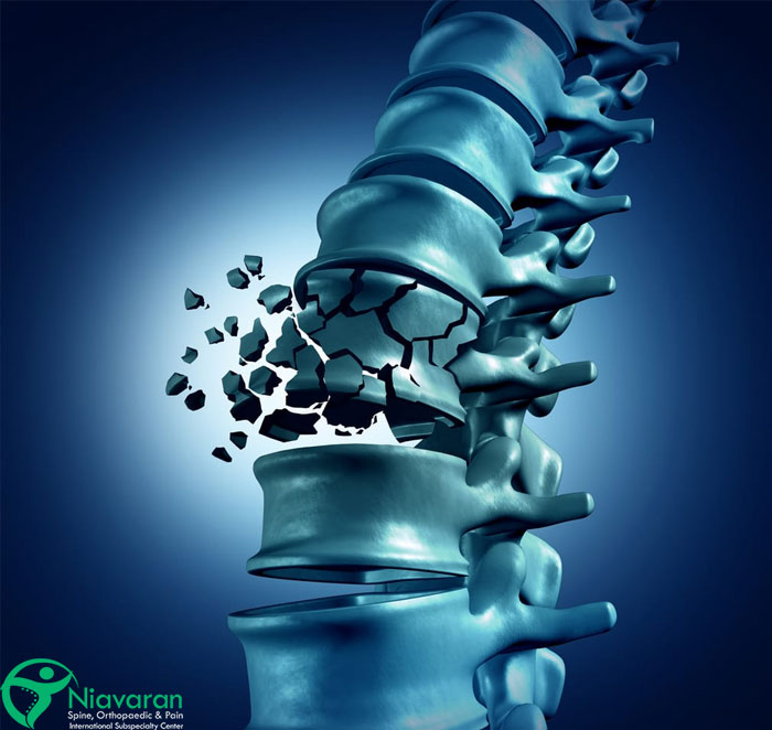 انواع شکستگی مهره های کمر