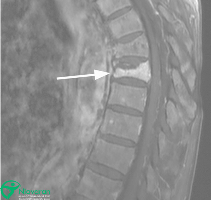 شکستگی مهره های کمر