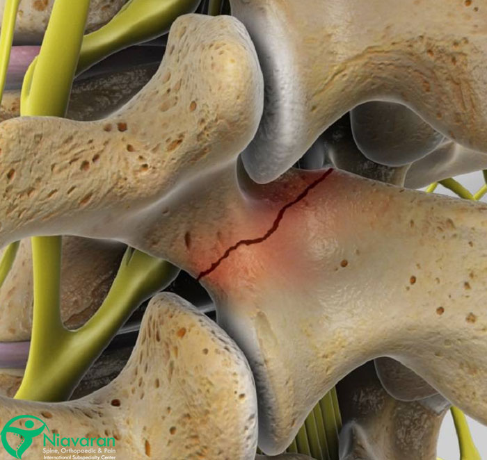 شکستگی مهره های کمر در سالمندان