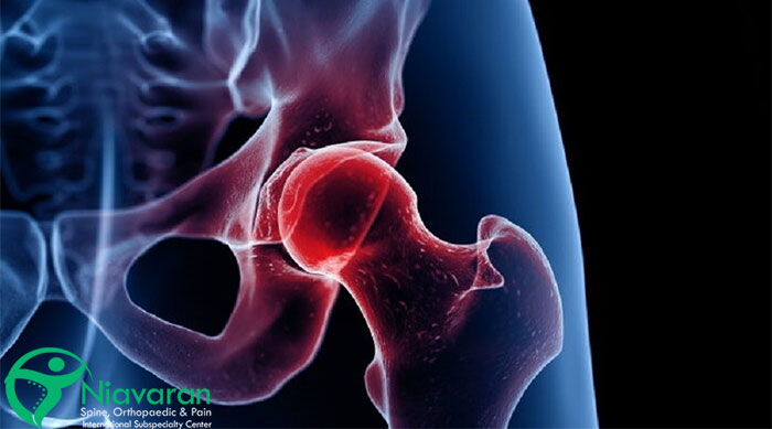 پارگی لابروم خلفی یا پشتی لگن