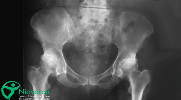 پارگی لابروم لگن چگونه تشخیص داده می‌شود؟