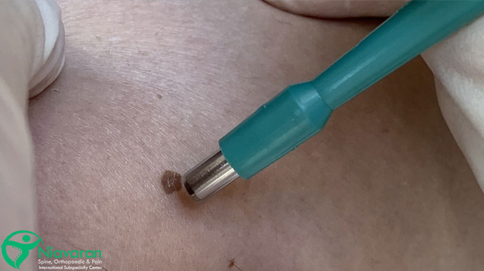 عوارض آزمایش بیوپسی