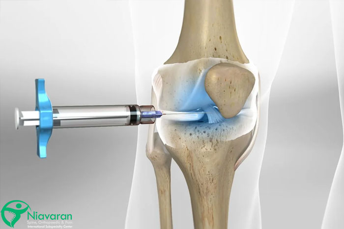 آیا تزریق ژل به زانو بهتر از جراحی است؟