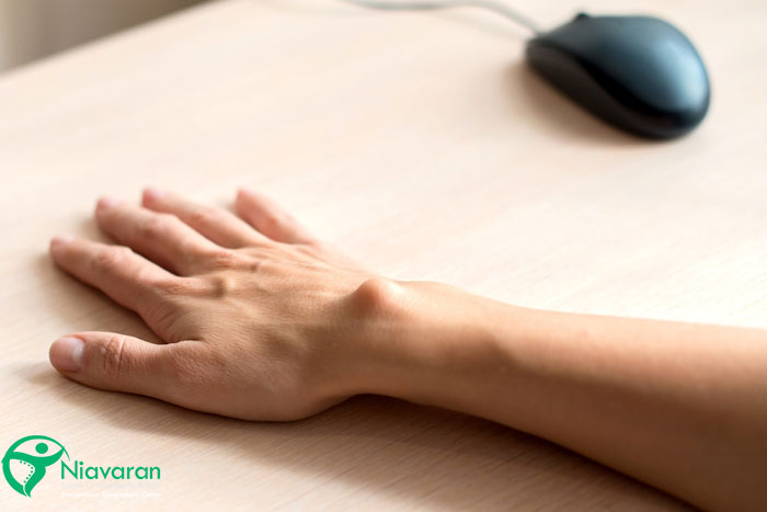 محل ایجاد کیست گانگلیون