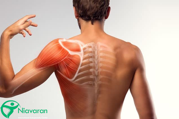 تشخیص سندروم گیر افتادگی شانه