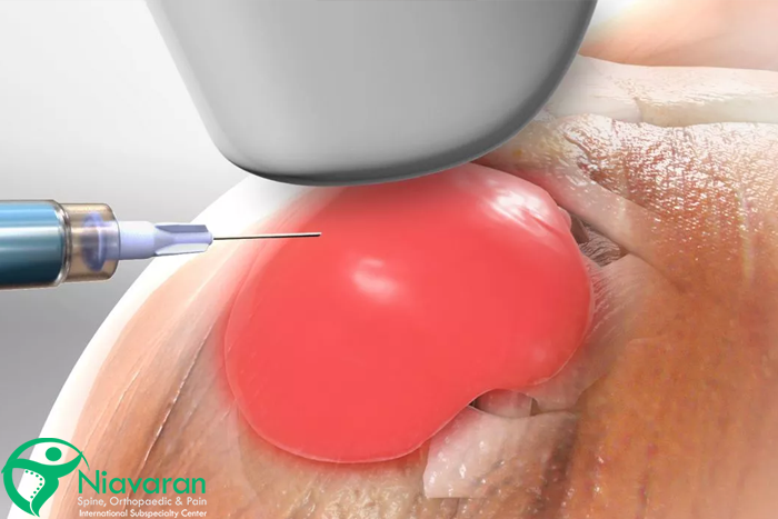 تزریق کورتیکواستروئید شانه