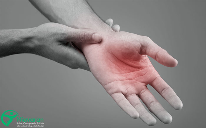 سندرم تونل کارپال