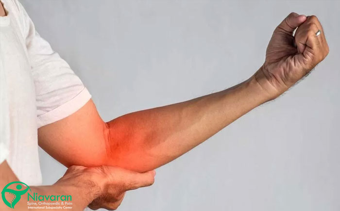 سندروم تونل کوبیتال