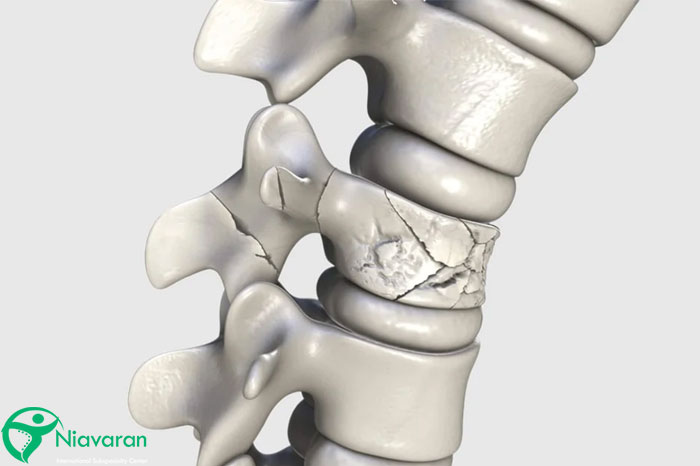شکستگی مهره های کمر
