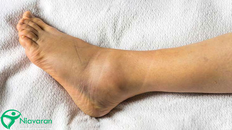 آب آوردن مچ پا