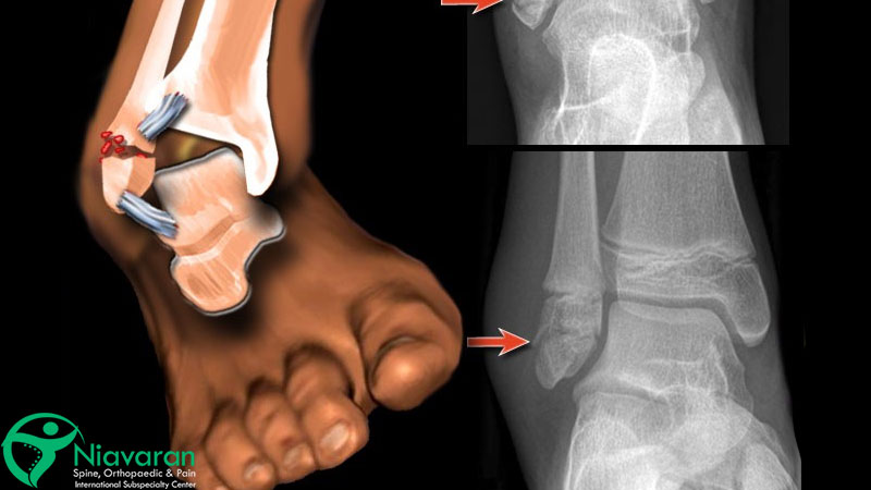 پیچ خوردگی مچ پا