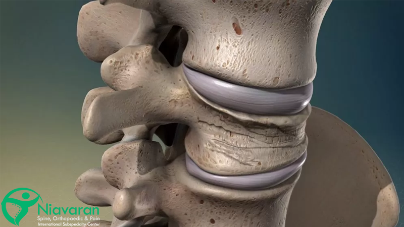 آسیب دیدگی مهره های گردن
